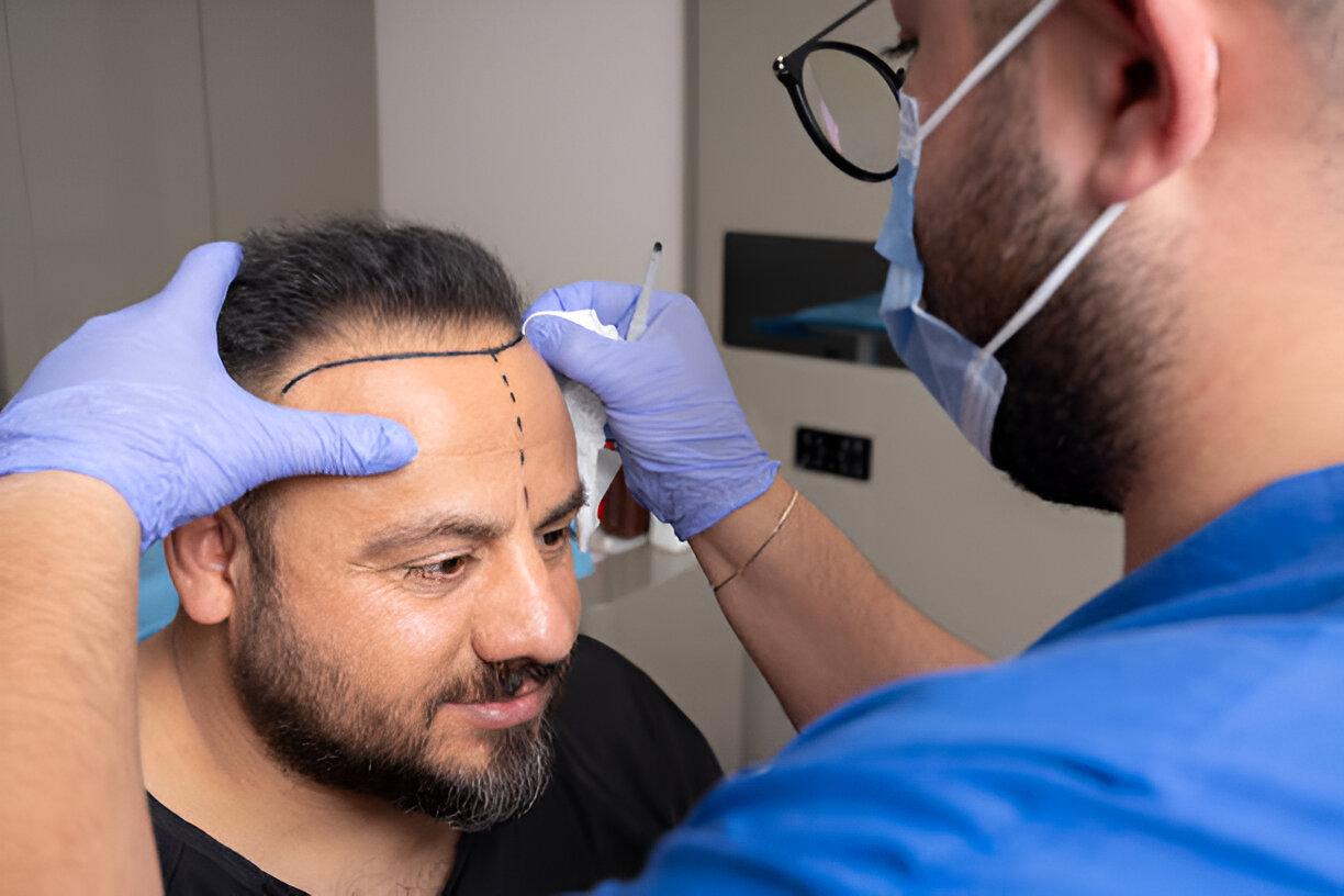 Hair Transplantation